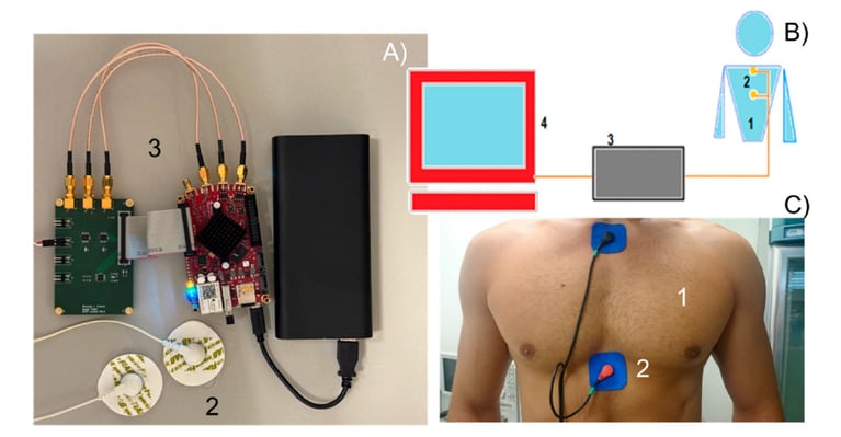 Non-Invasive GERD Detection: Continuous Esophageal Monitoring via Radiofrequency Spectrophotometry